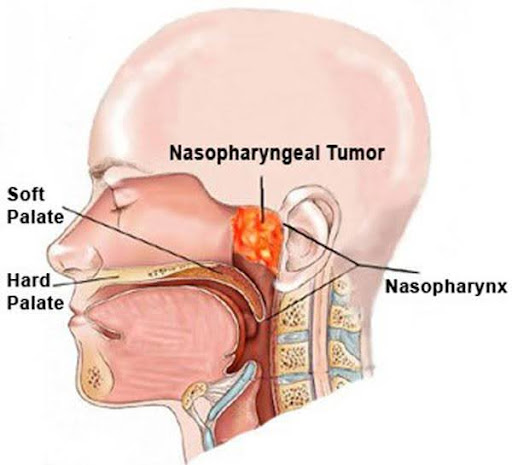 Nasopharyngeal Cancer treatment