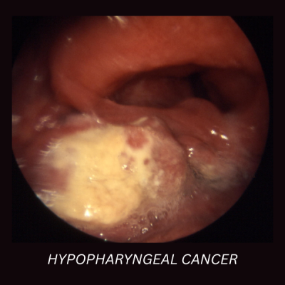 Hypopharyngeal Cancer