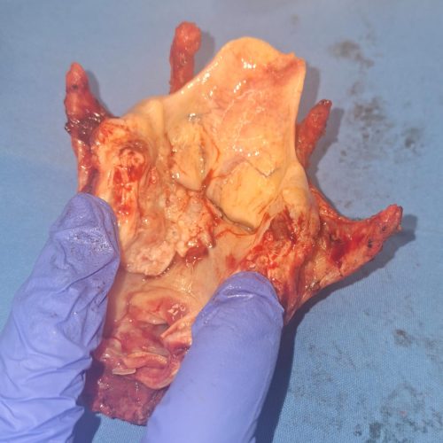 laryngeal cancer laryngeal cancer