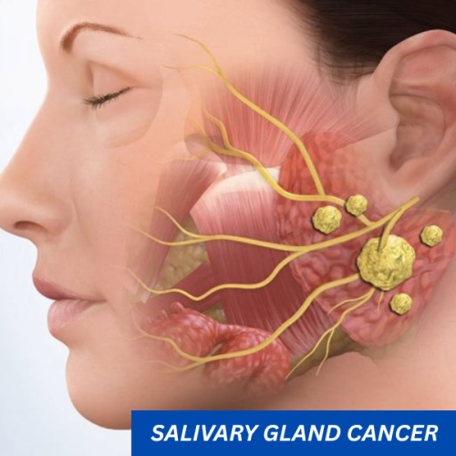 salivary gland cancer