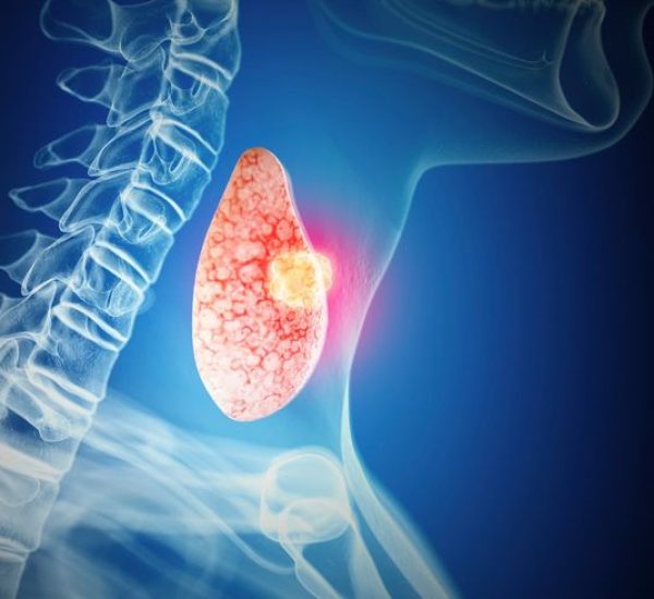 thyroid cancer thyroid cancer